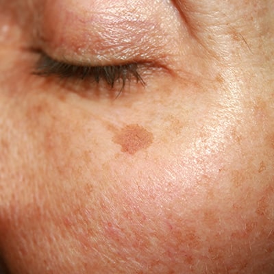 age spots on the face