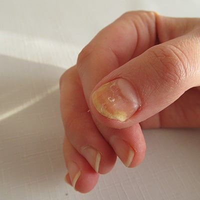 hand nail fungus
