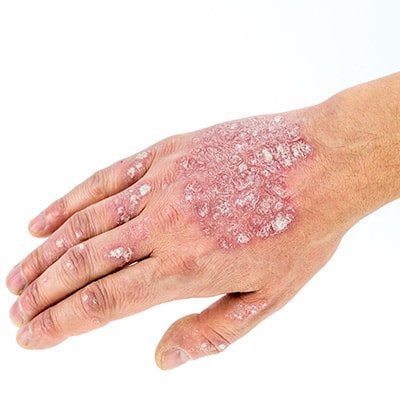psoriasis on the hand