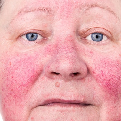 rosacea on the face