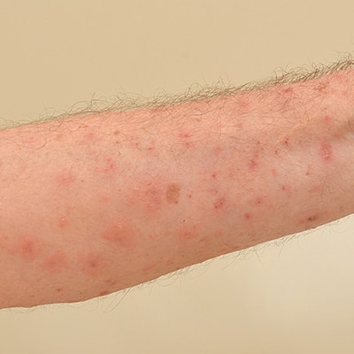 scabies on the skin