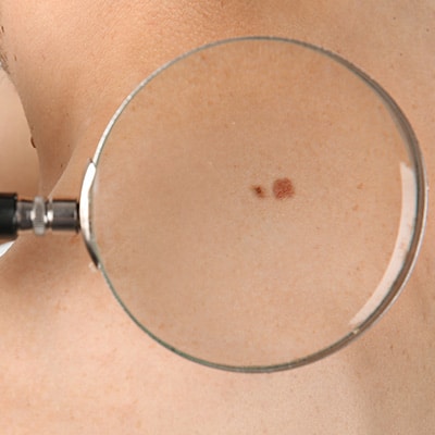 skin cancer under a magnifying glass