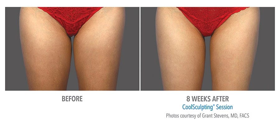 Coolsculpting - Before and 8 Weeks After