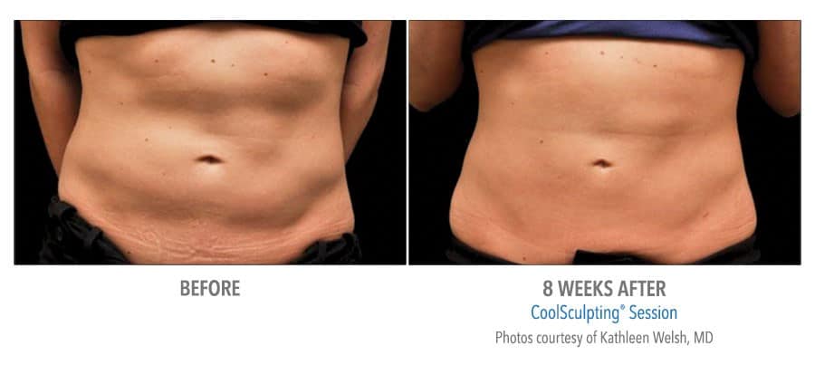 Coolsculpting - before and 8 Weeks After