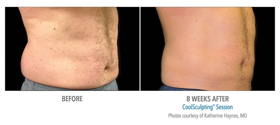 Coolsculpting - Before and 8 Weeks After