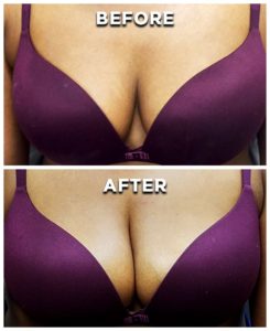 Breast PRP - Before and After