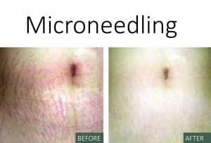 Microneedling - Back and After