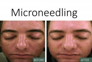 Microneedling - Back and After