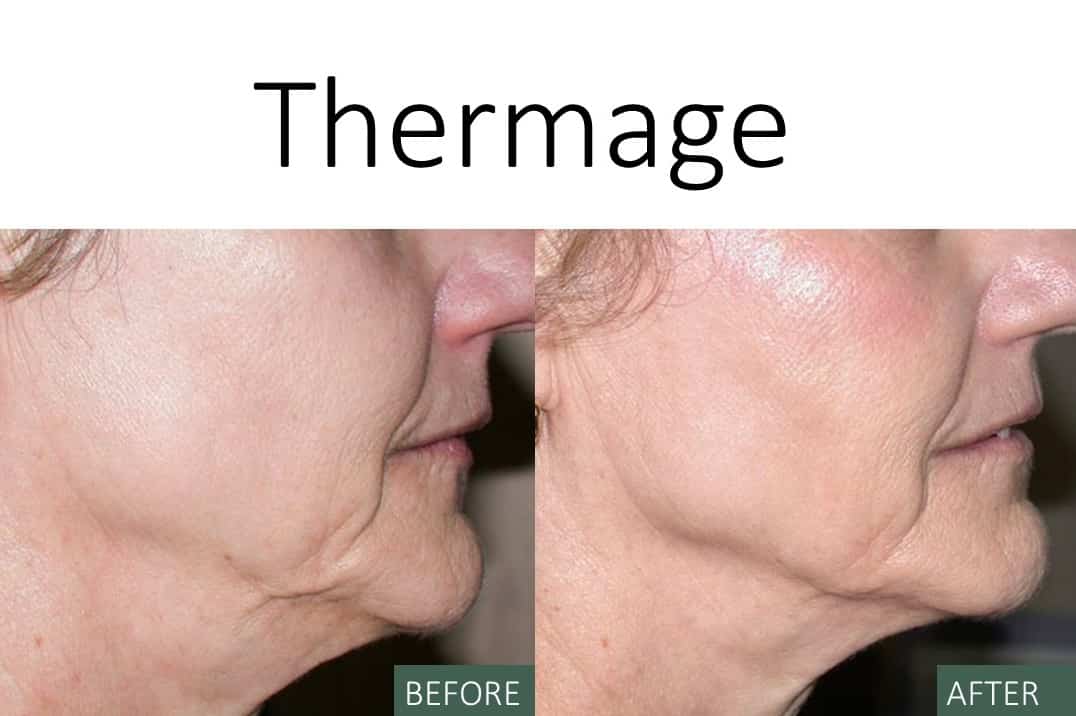 Thermage - Before and After