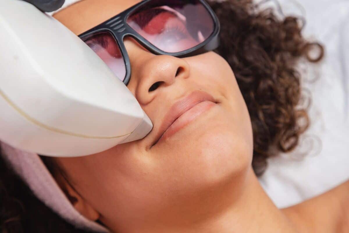 laser hair removal on woman's upper lip